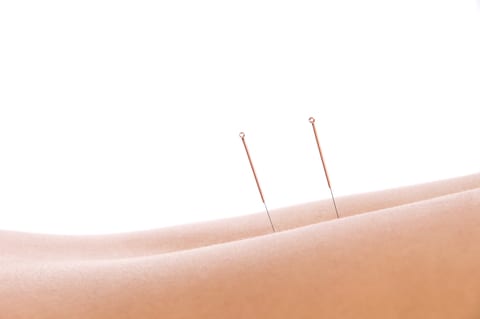 Acupuncture Mitcham Direct Physio