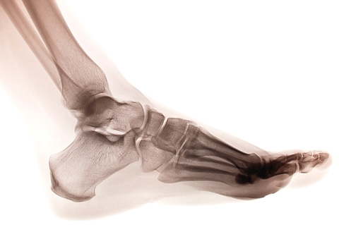 Ankle X-ray